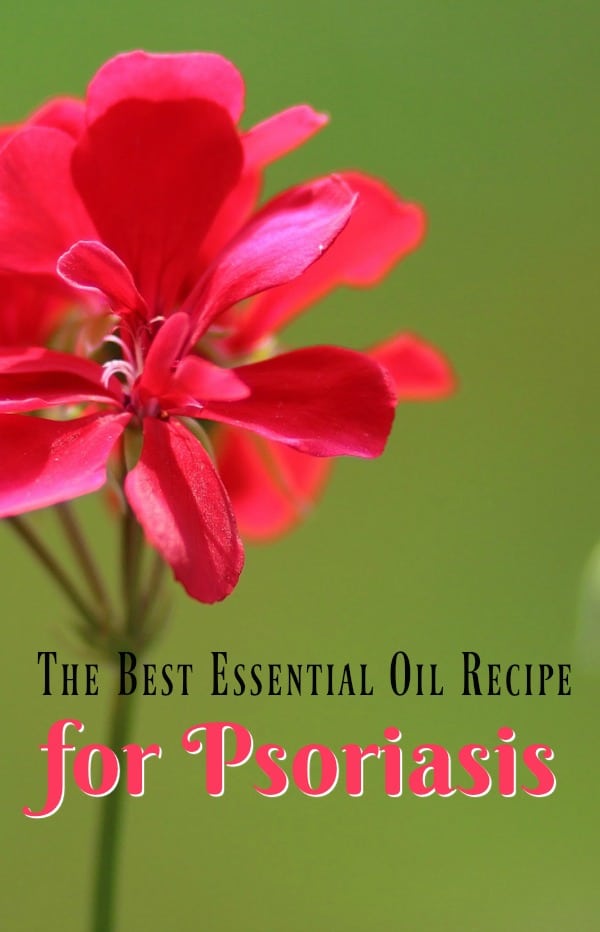 The Best Essential Oil Recipe for Treating Psoriasis