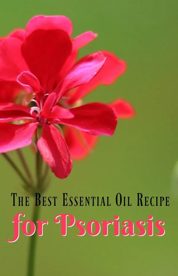 The Best Essential Oil Recipe for Treating Psoriasis