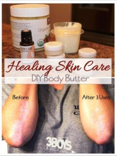 This DIY Healing All Over Body Butter can be used on your lips, skin, hair to relieve the symptoms and clear up rashes, psoriasis, eczema, cracked skin, and more!