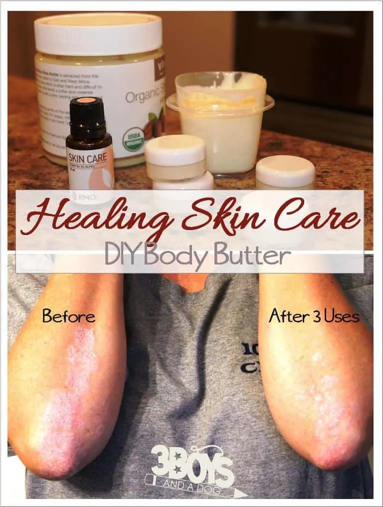 This DIY Healing All Over Body Butter can be used on your lips, skin, hair to relieve the symptoms and clear up rashes, psoriasis, eczema, cracked skin, and more!
