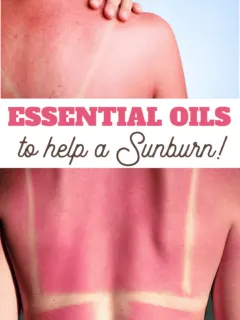 the best essential oils for sunburn