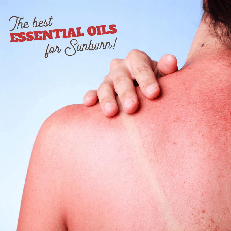 what essentials oils to use on a bad sunburn